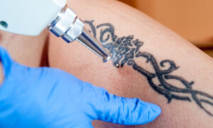 Les millennials adoraient les tatouages ​​– ils font désormais du retrait au laser la prochaine grande tendance
